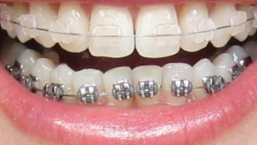 closing gap with braces